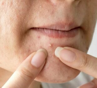 Living With Acne Acne