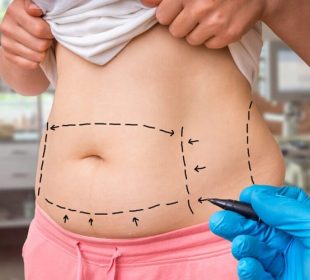 Get Rid of Excess Fat Using Liposuction Fat Using Liposuction