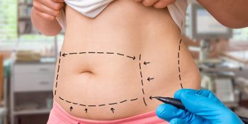 Fat Using Liposuction