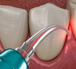 Everything You Need To Know About Laser Gum Surgery Laser Gum Surgery