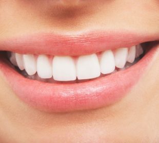 What You Need to Know About Teeth Whitening Teeth Whitening