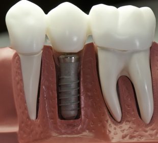 Here is What You Should Expect from Bone Grafting for Dental Implants Dental Implants