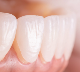All You Need To Know About Dental Veneers Dental Veneers