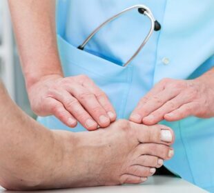 Treatments For Bunions