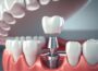 The All-On-4 Advantage: Why This Dental Implant Technique is Changing Lives Dental Implant